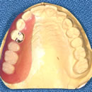 当院の入れ歯の種類と特徴
