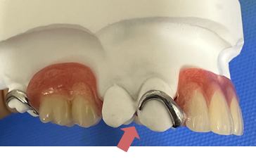 通常の保険適応義歯の場合2