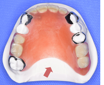 通常の保険適応義歯の場合3