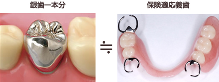 保険適応義歯：　義歯の保険での評価は低く、１０本以上歯がない場合でも、１本の銀歯と同じ程度となります。