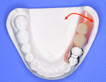 片側義歯では後方が沈みかつ左右に動いてしまいやすい