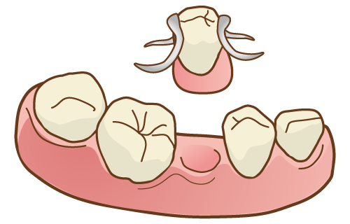 通常の義歯