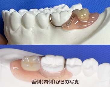 ミラクルデンチャーの場合